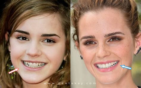 vampire veneers celebrities.